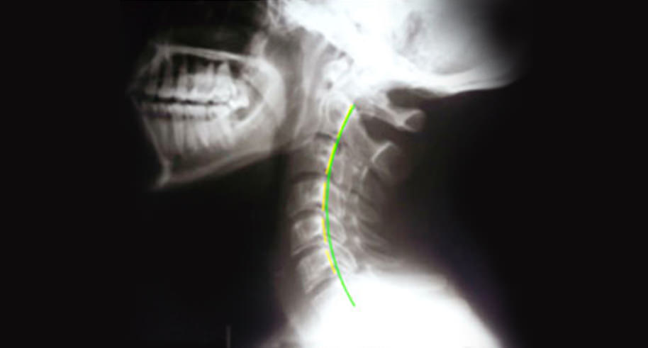 The Four Types of Cervical Curves