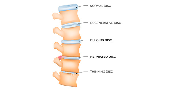 Bulging & Herniated Disc Chiropractic Treatment Techniques - Figure