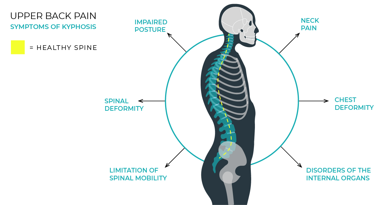 https://www.chiroone.com/wp-content/uploads/2021/04/blog-04-2021-kyphosis-posture-02.png