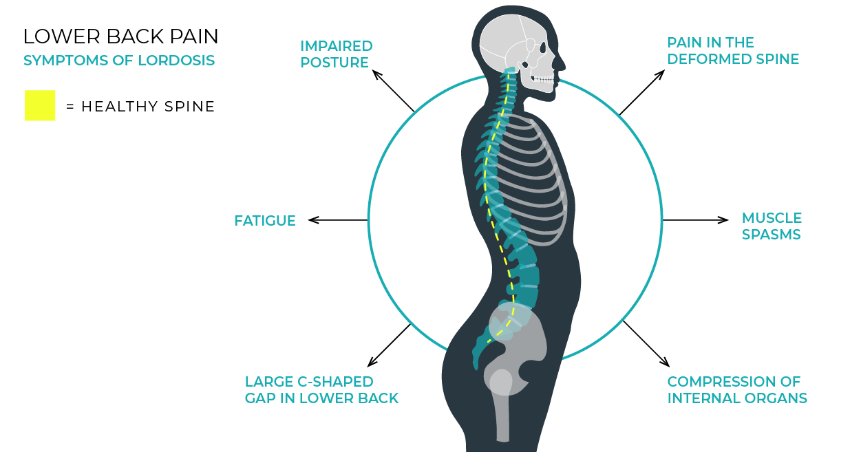 Chiropractic Treatments for Lower Back Pain and Lordosis (aka Swayback)