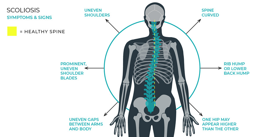 The Most Effective Chiropractic Treatments and Adjustments for Scoliosis