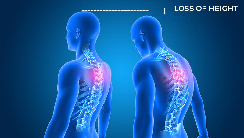 How Poor Posture Makes You Shorter - How Chiropractic Adjustments Can Help Make You Taller - Chiro One Wellness Centers