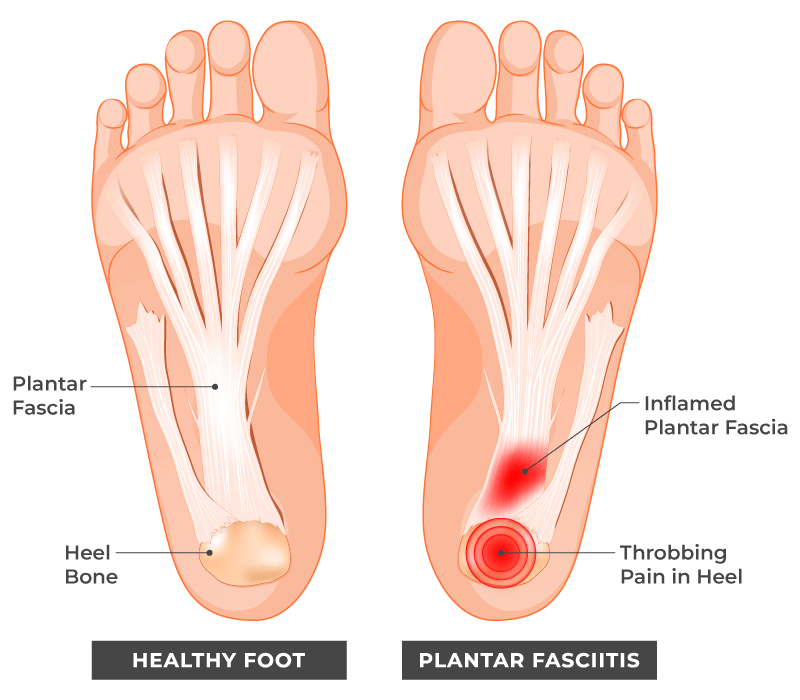 Example of Plantar Fascia