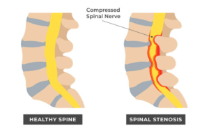 Graphic image shows the width of a normal spinal canal versus the constriction in a spinal canal that constitutes spinal stenosis