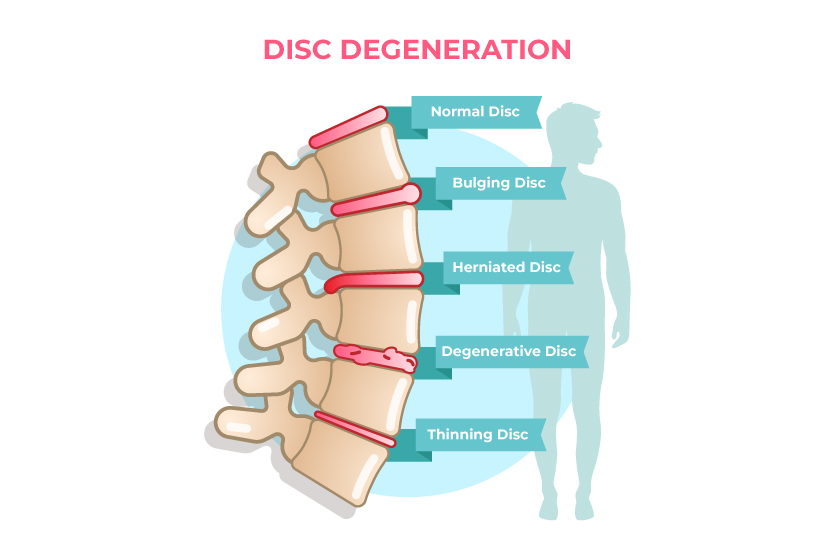An anatomical illustration labeled "Disc Degeneration" showing five stages of spinal disc problems: Normal Disc, Bulging Disc, Herniated Disc, Degenerative Disc, and Thinning Disc.